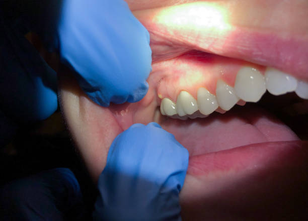 Best Emergency Treatment for Toothache in Villa Rica, GA