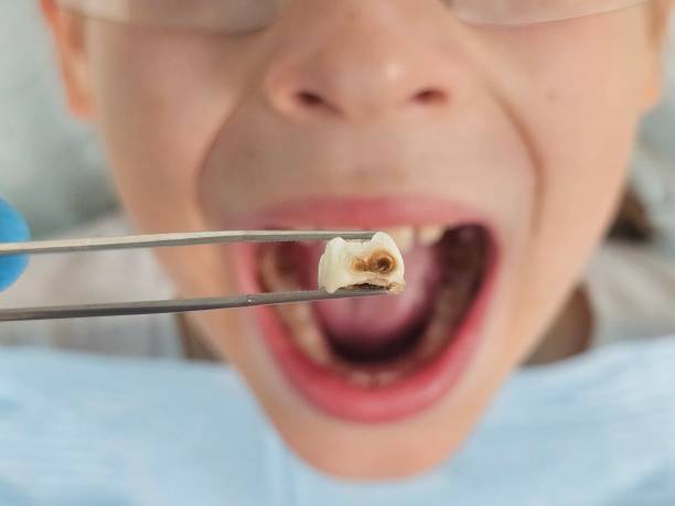 Best Emergency Wisdom Teeth Removal in Villa Rica, GA